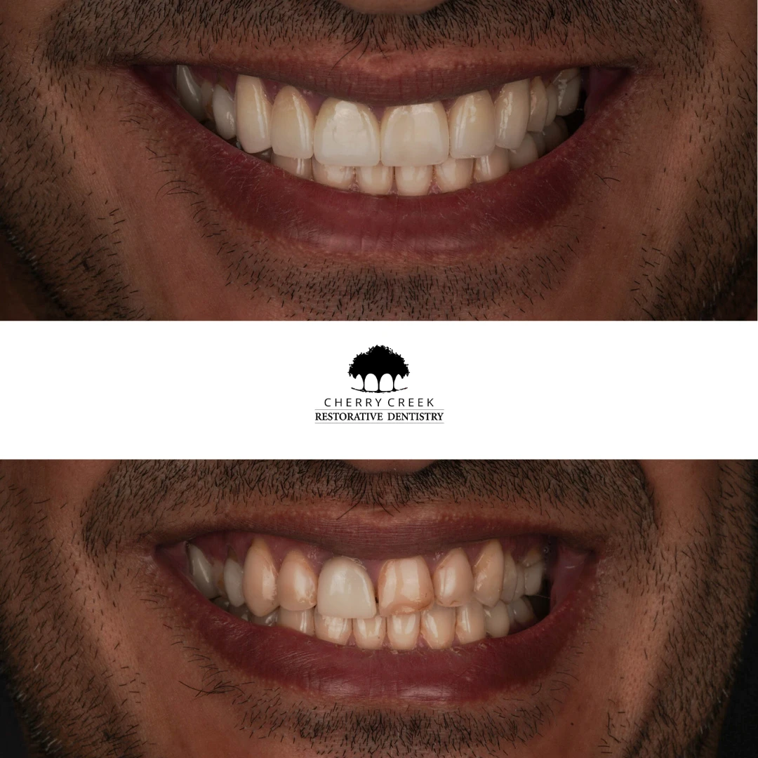 crown-veneers gallery
